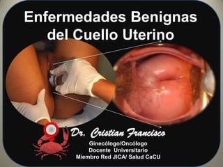 Enfermedades Benignas
del Cuello Uterino

Dr. Cristian Francisco
Ginecólogo/Oncólogo
Docente Universitario
Miembro Red JICA/ Salud CaCU

 