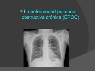  Laenfermedad pulmonar
obstructiva crónica (EPOC)
 