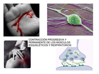 CONTRACCIÓN PROGRESIVA Y PERMANENTE DE LOS MÚSCULOS ESQUELÉTICOS Y RESPIRATORIOS 