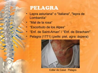 PELAGRA
• Lepra asturiana" o "italiana", "lepra de
Lombardía“
• “Mal de la rosa“
• “Escorbuto de los Alpes“
• “Enf. de Saint-Aman” / “Enf. de Stracham".
• Pelagra (1771) (pelle: piel, agra: áspera)
Collar de Casal : Pelagra
 
