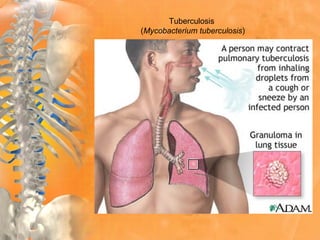 Tuberculosis
(Mycobacterium tuberculosis)
 