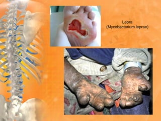 Lepra
(Mycobacterium leprae)
 