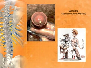 Gonorrea
(Neisseria gonorrhoeae)
 