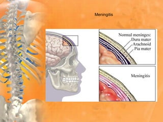Meningitis
 