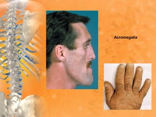 Acromegalia
 