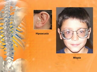 Miopía
Hipoacusia
 