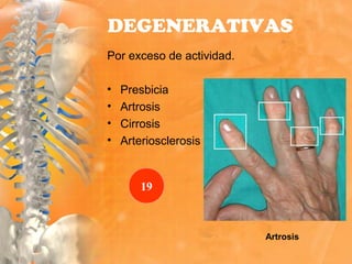 Por exceso de actividad.
• Presbicia
• Artrosis
• Cirrosis
• Arteriosclerosis
DEGENERATIVAS
Artrosis
19
 