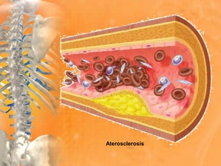 Aterosclerosis
 