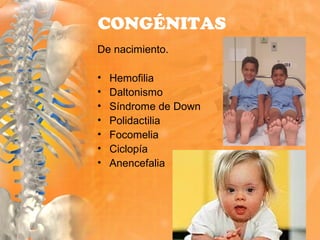 De nacimiento.
• Hemofilia
• Daltonismo
• Síndrome de Down
• Polidactilia
• Focomelia
• Ciclopía
• Anencefalia
CONGÉNITAS
 