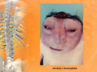 Acrania / Anencefalia
 
