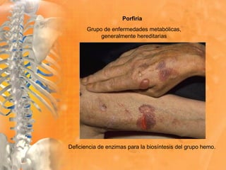 Deficiencia de enzimas para la biosíntesis del grupo hemo.
Porfiria
Grupo de enfermedades metabólicas,
generalmente hereditarias
 