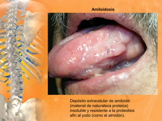 Amiloidosis
Depósito extracelular de amiloide
(material de naturaleza proteica)
insoluble y resistente a la proteolisis
afin al yodo (como el almidón).
 