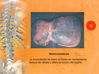 Hemocromatosis
La acumulación de hierro en forma de hemosiderina
lesiona las células y altera la función del órgano.
21
 