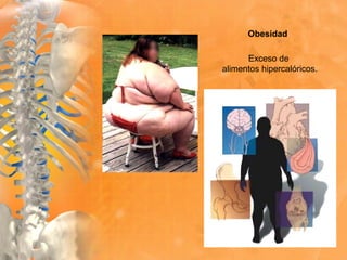 Obesidad
Exceso de
alimentos hipercalóricos.
 