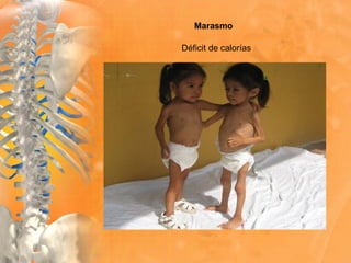 Marasmo
Déficit de calorías
 