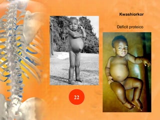 Kwashiorkor
Déficit proteico
22
 