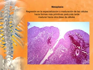 Metaplasia
Regresión en la especialización o maduración de las células
hacia formas más primitivas para más tarde
madurar hacia otra clase de células
 