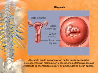 Alteración en de la maduración de las células epiteliales
que experimentan proliferación y alteraciones citológicas atípicas
Afectando la orientación celular y el tamaño dentro de un epitelio.
Displasia
 