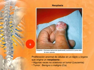 Neoplasia
Proliferación anormal de células en un tejido u órgano
que origina un neoplasma :
• Algunas veces no ocasiona un tumor (Leucemia)
• Tumor : Benigno o maligno (Ca)
6
 