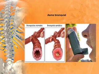 Asma bronquial
 