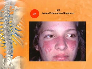LES
Lupus Eritematoso Sistémico23
 