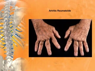 Artritis Reumatoide
 