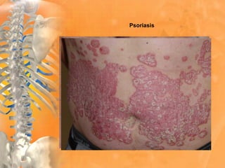 Psoriasis
 