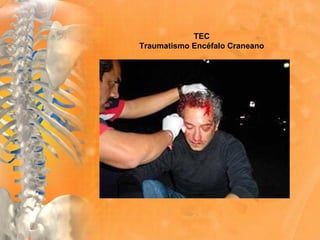 TEC
Traumatismo Encéfalo Craneano
 