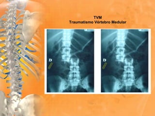 TVM
Traumatismo Vértebro Medular
 