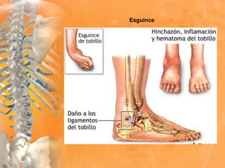 Esguince
 