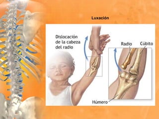 Luxación
 