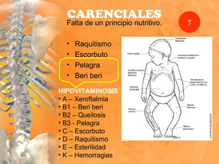 CARENCIALES
Falta de un principio nutritivo.
• Raquitismo
• Escorbuto
• Pelagra
• Beri beri
HIPOVITAMINOSIS
• A – Xeroftalmia
• B1 – Beri beri
• B2 – Queilosis
• B3 - Pelagra
• C – Escorbuto
• D – Raquitismo
• E – Esterilidad
• K – Hemorragias
7
 