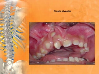 Fisula alveolar
 