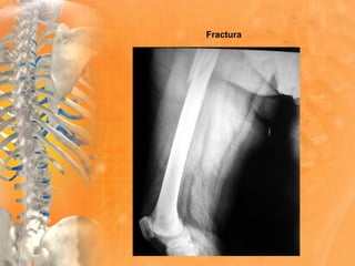 Fractura
 