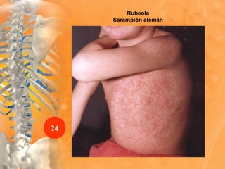 Rubeola
Sarampión alemán
24
 