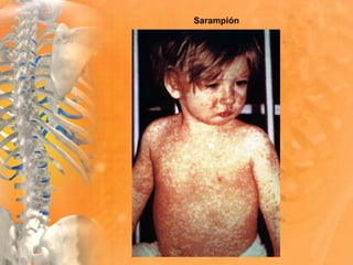 Sarampión
 