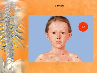 Varicela
12
 