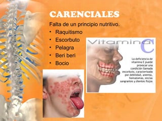 CARENCIALES
Falta de un principio nutritivo.
• Raquitismo
• Escorbuto
• Pelagra
• Beri beri
• Bocio
 