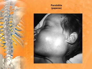 Parotiditis
(paperas)
 