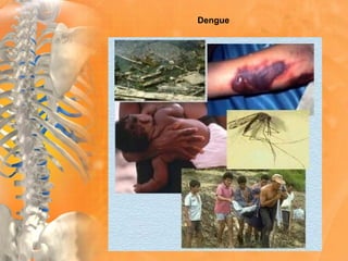 Dengue
 