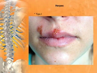 Herpes
* Tipo I
 