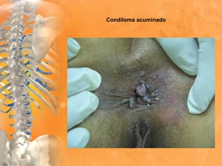 Condiloma acuminado
 