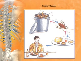 Fiebre Tifoidea
 