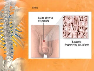 Sífilis
 