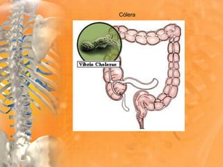 Cólera
 