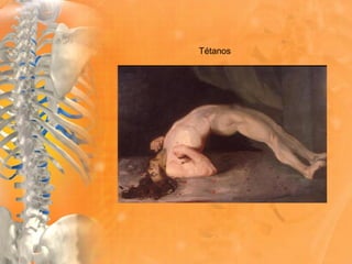 Tétanos
 