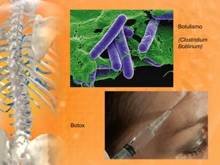 Botulismo
(Clostridium
Botilinum)
Botox
 