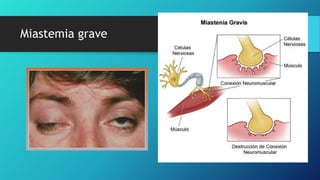 Miastemia grave
 