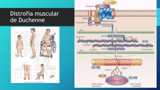 Distrofia muscular
de Duchenne
 