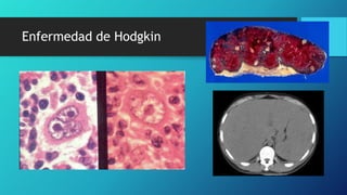 Enfermedad de Hodgkin
 